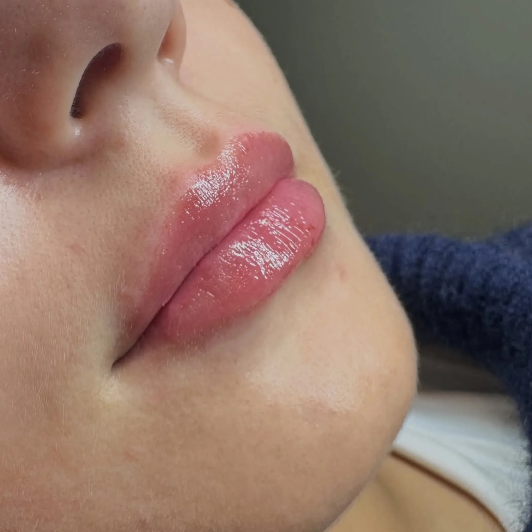 lip filler treatment