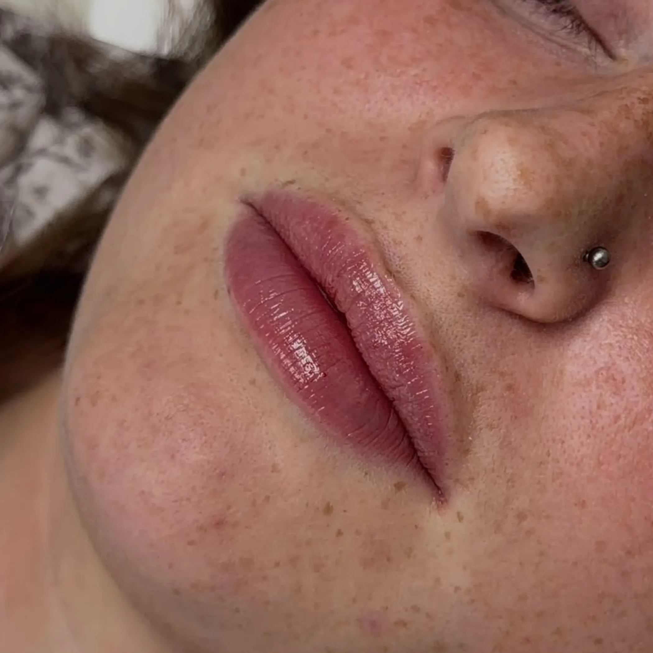 lips relevant to facial filler