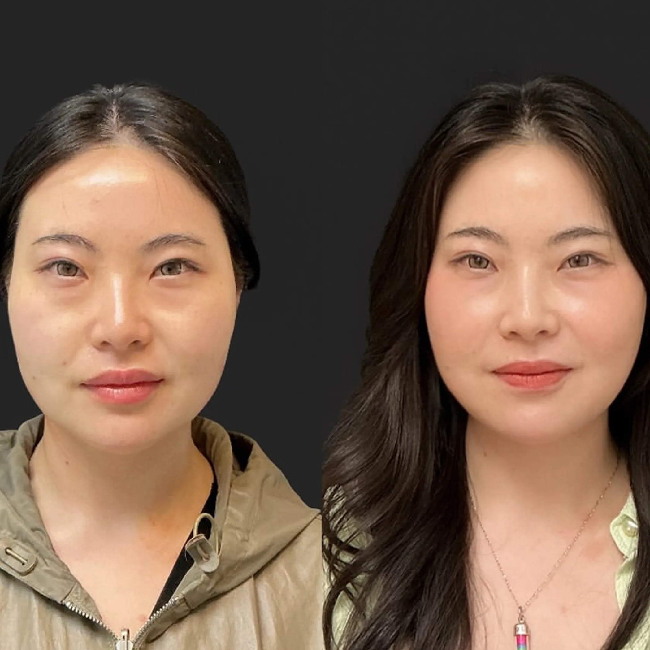 before-and-after facial volume restoration portrait