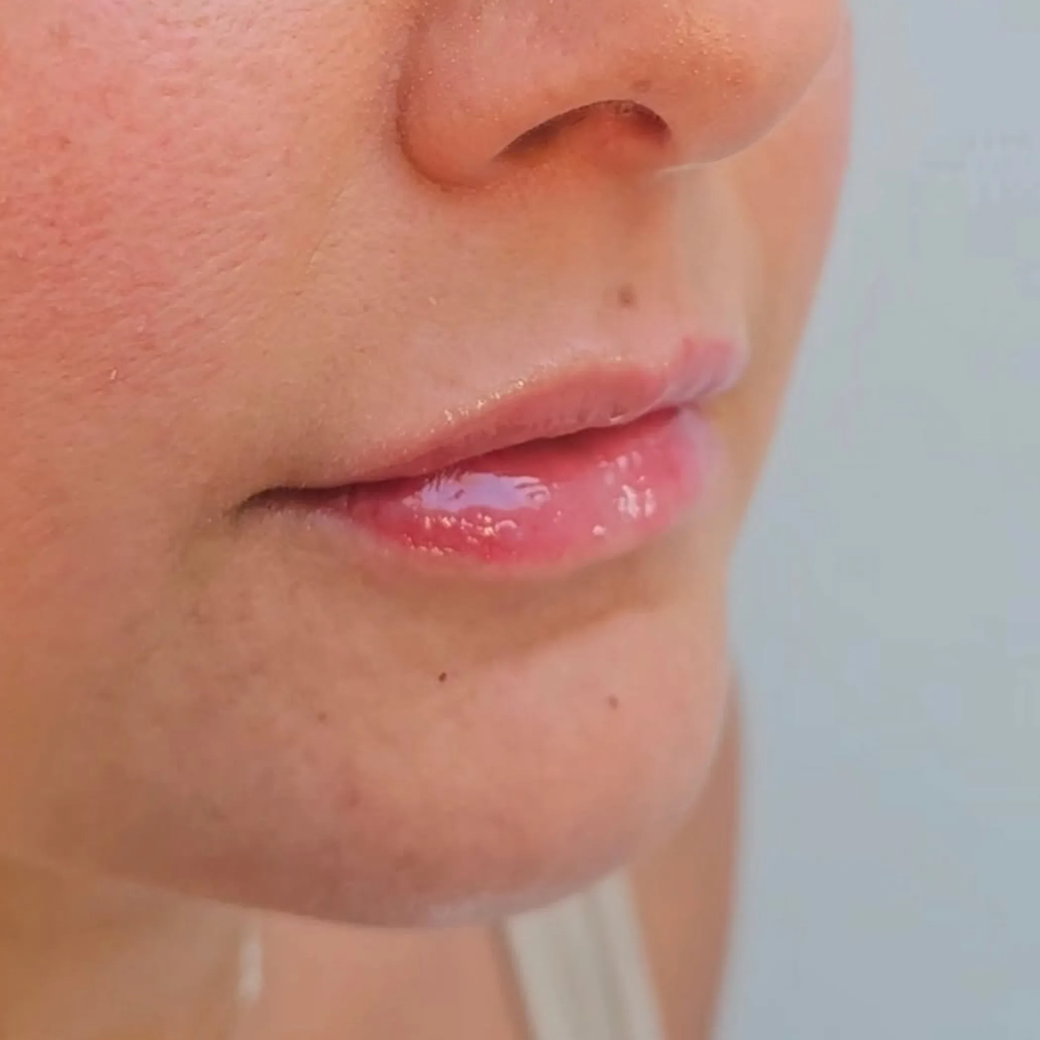 lip filler facial enhancement